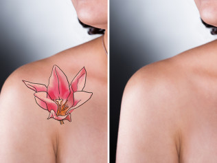 laser tattoo removal richmond va east coast laser tattoo removal laser tattoo removal richmond va east coast laser tattoo removal