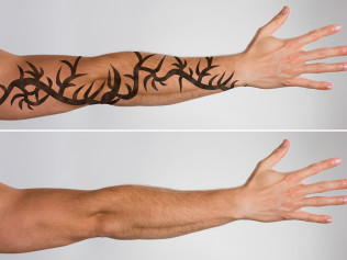 laser tattoo removal richmond va east coast laser tattoo removal laser tattoo removal richmond va east coast laser tattoo removal
