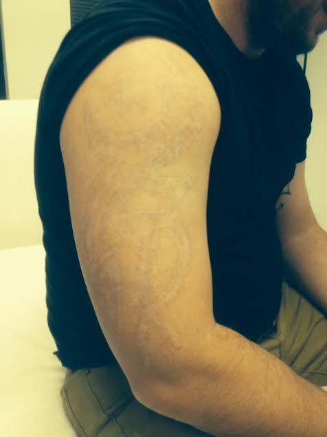 Laser Tattoo Removal  Richmond  Mechanicsville VA