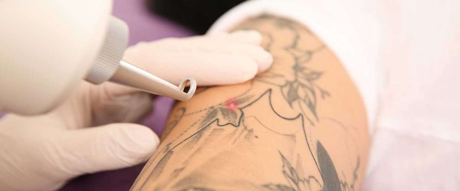 Accelerated Tattoo Removal Treatment  Vanish Laser Clinic Alexandria VA