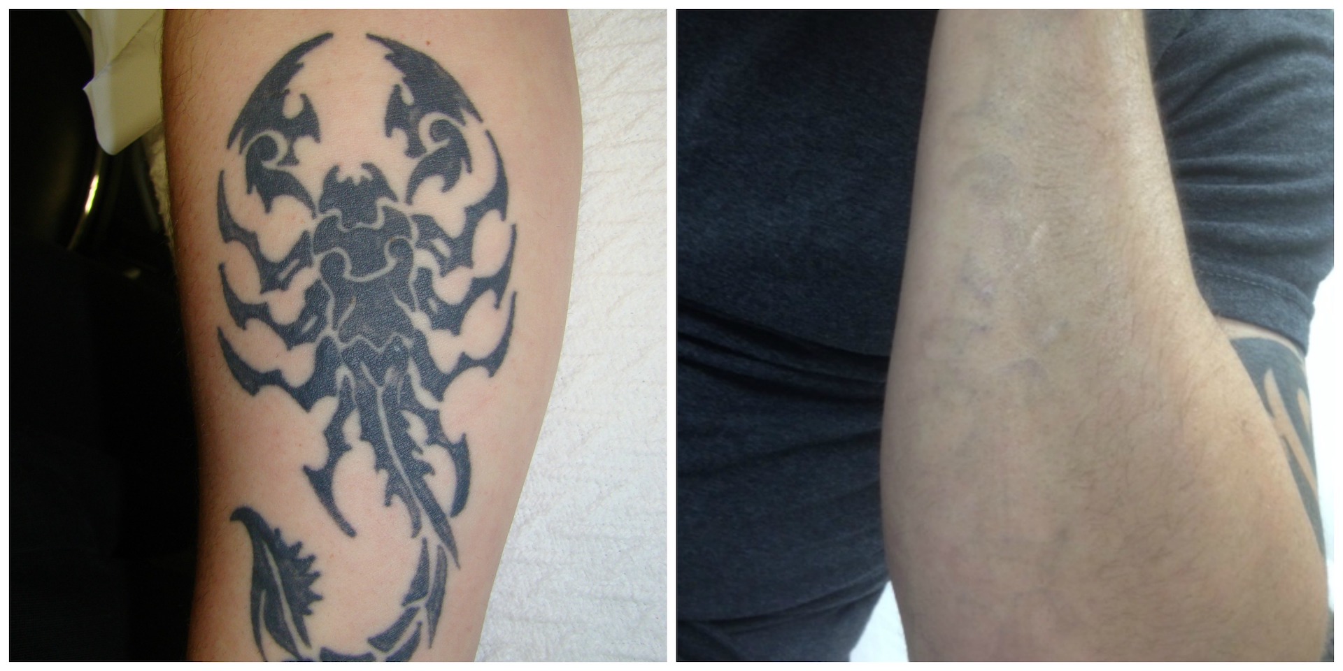Tattoo removal facts about non-laser removal: saline, acid, oxides | Lynch  Dermapigmentology